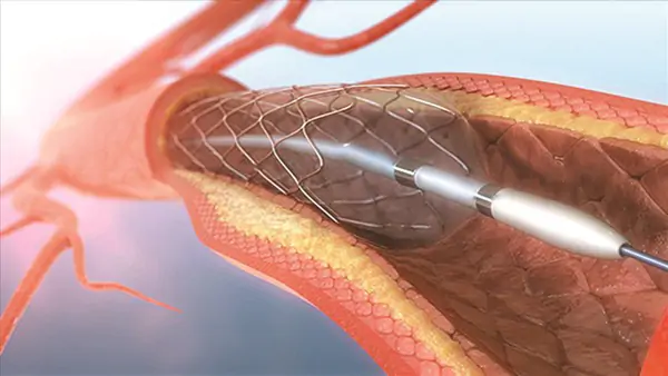 Đặt Stent có thực sự cần thiết?